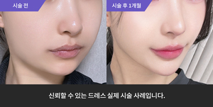 티타늄 + 암살주사