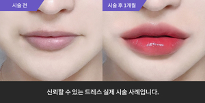 입술필러