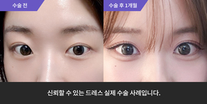 자연유착재수술 + 눈매교정 + 윗트임