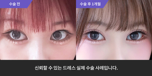 자연유착재수술 + 앞트임 + 윗트임