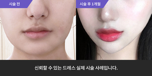 턱필러 + 사각턱보톡스 + 울쎄라 + 슈링크