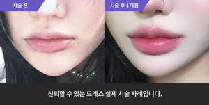 입술필러