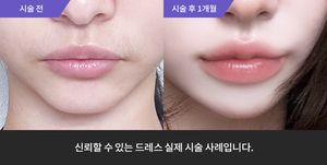 입술필러
