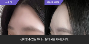 이마필러