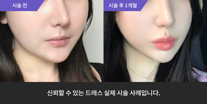 입술필러 + 리프테라