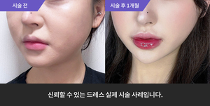 암살주사