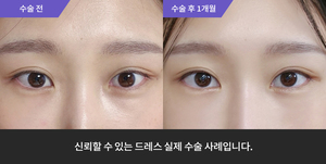 뒷트임+밑트임+앞트임+윗트임