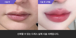 입술필러