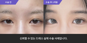 자연유착 + 눈매교정재수술