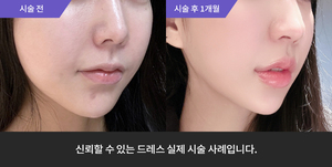 실리프팅 + 입술필러
