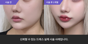 암살주사 + 티타늄리프팅 + 입술필러