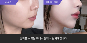 티타늄리프팅 + 턱필러