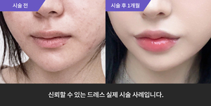 입술필러+티타늄