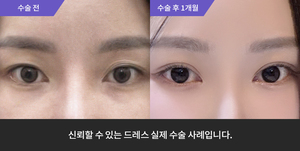자연유착 + 눈매교정