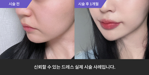 암살주사 + 입술필러
