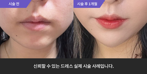 암살주사 + 턱필러