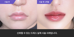 입술필러