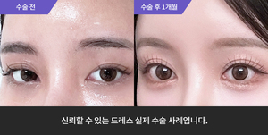 자연유착 + 눈매교정 재수술