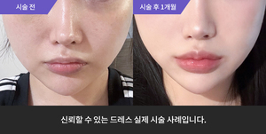 입술필러 + 티타늄