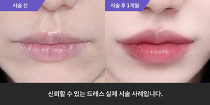 입술필러