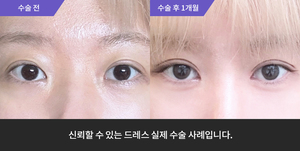 자연유착재수술 + 앞트임 + 윗트임