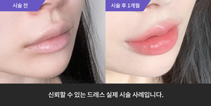 입술필러