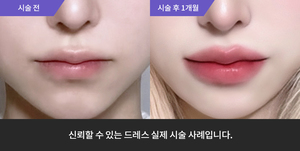 입술필러