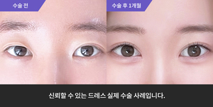 자연유착재수술 + 눈매교정 + 앞트임 + 윗트임