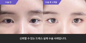 자연유착재수술 + 눈매교정재수술 + 윗트임