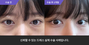 자연유착재수술