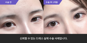 자연유착재수술 + 눈매교정재수술 + 윗트임