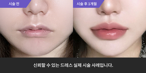 입술필러