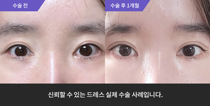 자연유착재수술 + 윗트임