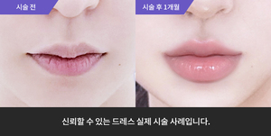 입술필러