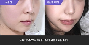 울쎄라 + 암살주사