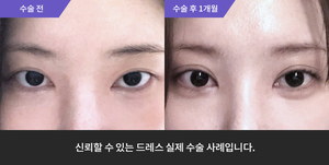 자연유착재수술 + 눈매교정