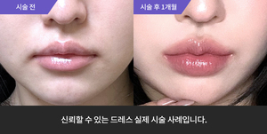 입술필러