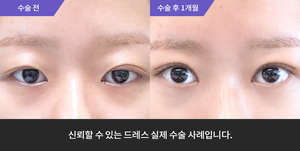 자연유착재수술 + 눈매교정 + 앞트임 + 윗트임