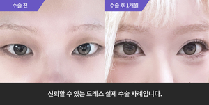 자연유착 + 눈매교정