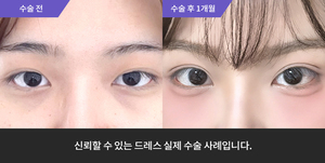 자연유착 + 눈매교정