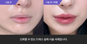 입술필러