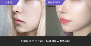 티타늄