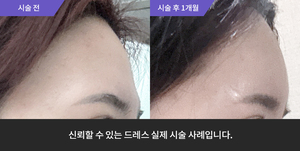 이마필러