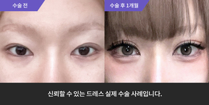 자연유착재수술 + 눈매교정재수술