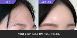 이마필러