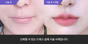 입술필러