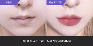 입술필러