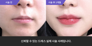입술필러