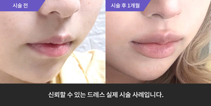입술필러