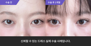 자연유착재수술 + 눈매교정 + 윗트임
